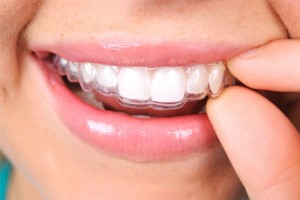 ortodoncia-invisalign-en-paiporta