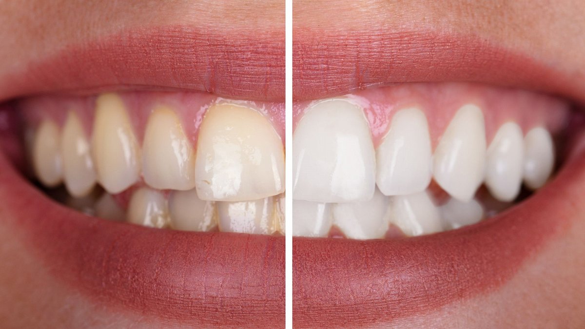 Blanqueamiento Dental Blanqueamiento Dental