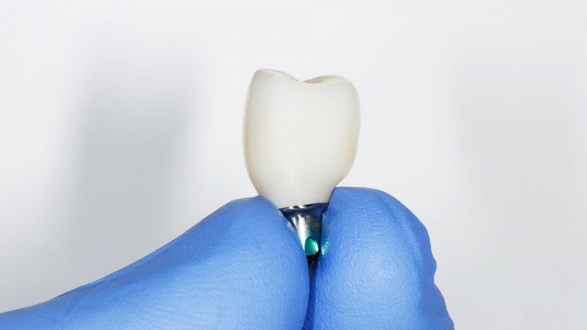 Coronas de Zirconio qué son, tipos Coronas de Zirconio qué son, tipos