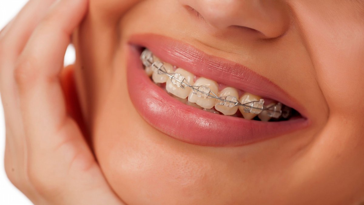 brakets metálicos cuando es mejor utilizarlos brakets metálicos cuando es mejor utilizarlos