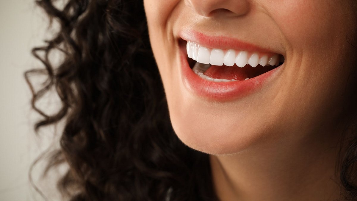 carillas dentales