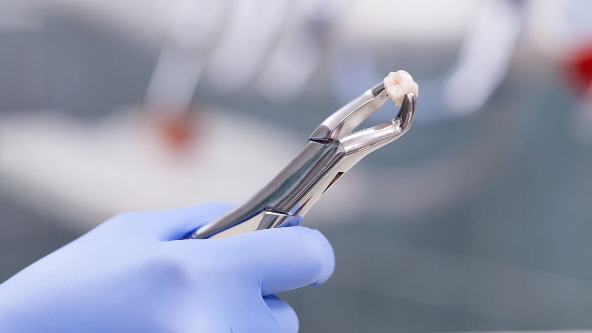 extracción dental extracción dental